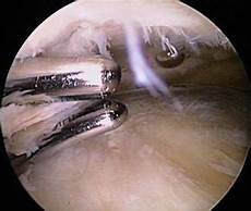 Arthroscopic Implant