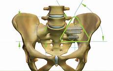 Back Bone Implant