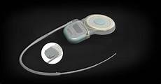 Cochlear Implant System