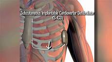 Implantable Cardiac Monitor