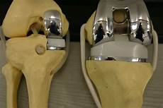 Knee Implant