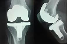 Knee Implant
