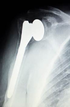 Orhtopedic Implant