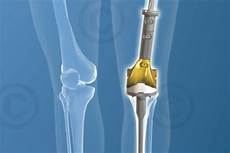 Ortheopedic Implants