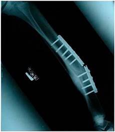 Orthoapedic Implants