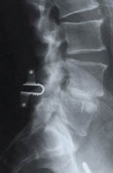 Orthopaedic Implant