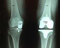 Orthopedic Surgery Implants