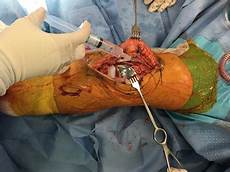 Orthopedic Surgery Implants