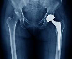 Orthopedics Implants