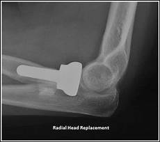 Ortopedic Implants
