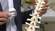 Spine Implant