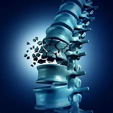 Spine Implant