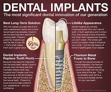 Swiss Implants